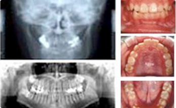 ２．歯列矯正前の精密検査
