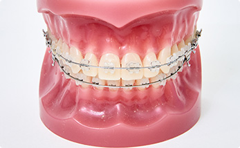 ５．歯列矯正装置の装着